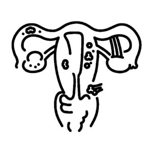 Endometriosis