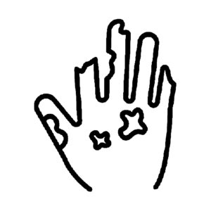 Leprosy