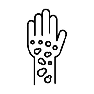 Psoriasis